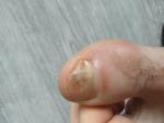 Проблема с ногтевой пластиной большого пальца, на ноге фото 1