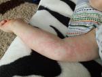 Атопический дерматит аллергия фото 2