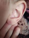 Сосудистые точки на мочке уха фото 2