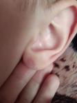 Сосудистые точки на мочке уха фото 1