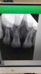 Ушиб зуба, сломан корень фото 1