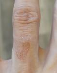 Появление красного пятна на пальце левой руки фото 1