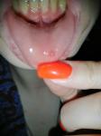 Пузырек на внутренней стороне нижней губы фото 4