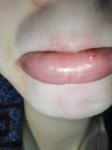 Пузырек на внутренней стороне нижней губы фото 1