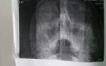 Гайморит повторный рентген фото 1