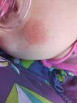 Аллергия красные пятна на лице фото 3