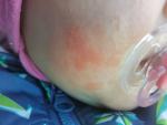 Аллергия красные пятна на лице фото 1