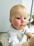 Аллергия у ребенка 10 месяцев фото 2