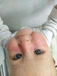 Аллергия у ребенка 10 месяцев фото 1