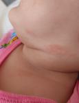 Сыпь на шее у ребенка 6 месяцев фото 3