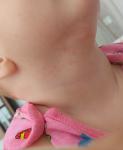 Участки гиперемии в области шеи у ребенка 6 месяцев фото 3
