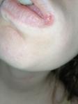 Болячка на губе после лечения зуба фото 1