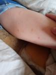 Синяки на ногах у ребёнка 4 года фото 1