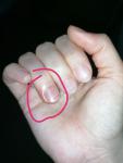 Почему опух палец вокруг ногтя? фото 1