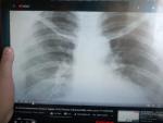 Рентгенаграфия легких фото 2