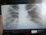 Рентгенаграфия легких фото 1
