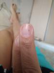 Черная точка-риска на ногте, которая отрастает и снова появляется фото 1
