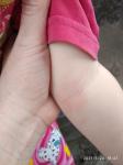 Красные пятна на руках у ребенка фото 4