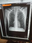 Рентген грудной клетки, состояние после ВАТС резекции фото 1