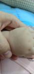 Белые пятнышки на коже на обеих ручках младенца 9 месяцев фото 1