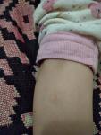 Розовое пятно на ноге ребенка больше 2 месяцев фото 1