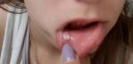 Плотность в области рта на губе фото 1