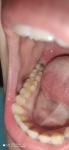 Воспаление слизистой рта фото 3