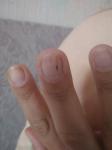 Черная точка-риска на ногте, которая отрастает и снова появляется фото 2