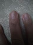 Черная точка-риска на ногте, которая отрастает и снова появляется фото 3