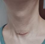 Изменилась шея после операции фото 1