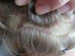 Микоз гладкой кожи и волосистой части фото 2