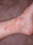 Красные точки на ноге в форме пятна боли в пятке фото 1