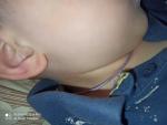 Пятна, сыпь на шее у ребенка фото 2