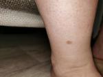 Пятнышко на ноге коричневого цаета фото 1