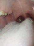 Белый налёт, наросты в горле, и белая наросты на миндалине фото 2