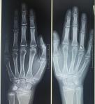 Рентген на костный возраст. Прогноз фото 1