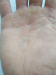 Шелушение кожи рук фото 2