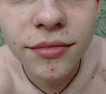 Сыпь на лице подростка фото 3