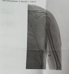 Травма плеча, растяжение или разрыв фото 1