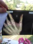 Боль в межфаланговом суставе большого пальца руки фото 1
