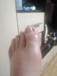 Боль в Косте на большом пальце на ноге фото 2