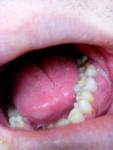 Болит между зубов фото 1