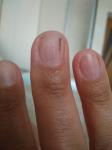 Черная точка-риска на ногте, которая отрастает и снова появляется фото 4