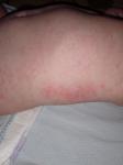 Алергия или потница фото 1
