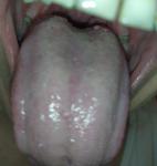 Образование сбоку языка, пощипывание языка, боль в горле справа фото 2