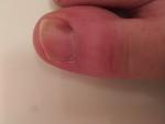 Подногтевая меланома или нет, большой палец правой стопы фото 1