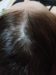 Облысения выпадение волос после окрашивания фото 1