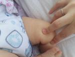 Сыпь у грудного ребенка фото 4