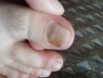 Пятно под ногтем большого пальца правой ноги фото 1