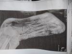Перелом плюсневой пятой кости со смещением фото 2
